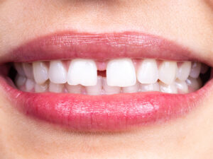 diastema