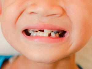 problemas bucais mais comuns em crianças