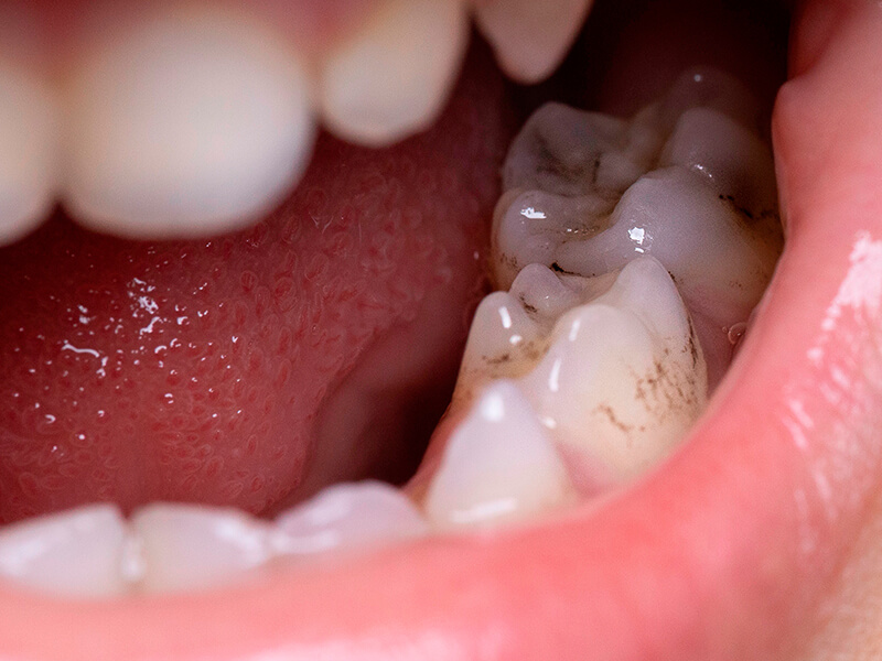 dente com cárie