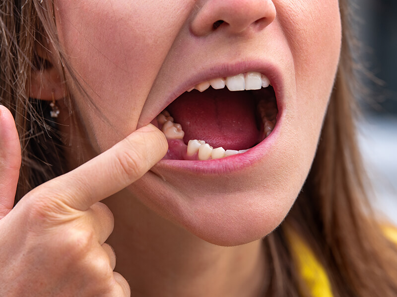 mulher com dente faltando